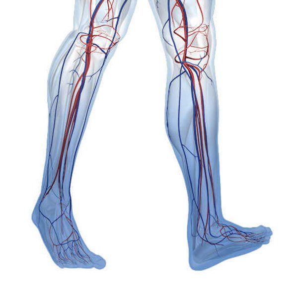 Darstellung der Anatomie von Beinen mit einer Erkrankung an einer chronisch-venösen Insuffizienz (CVI). Dahinter verbirgt sich eine allgemeine Venenschwäche.